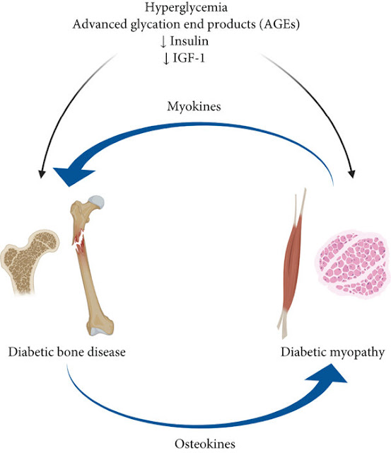 Infographic showing Bone diseases due to diabetes process