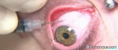 eye bacanaus copy