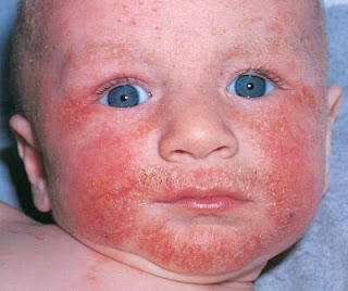 What Are Causes of Atopic Dermatitis