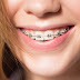 Niềng răng hàm dưới có lợi ích gì? 