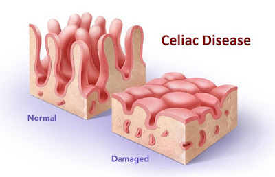 Obat Tradisional Celiac