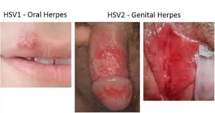  United State HSV-1 Have 50%, And HSV-2 15.5% Herpes Diseases By Vaginal, Anal or Oral Sex || SEXUAL DISEASES