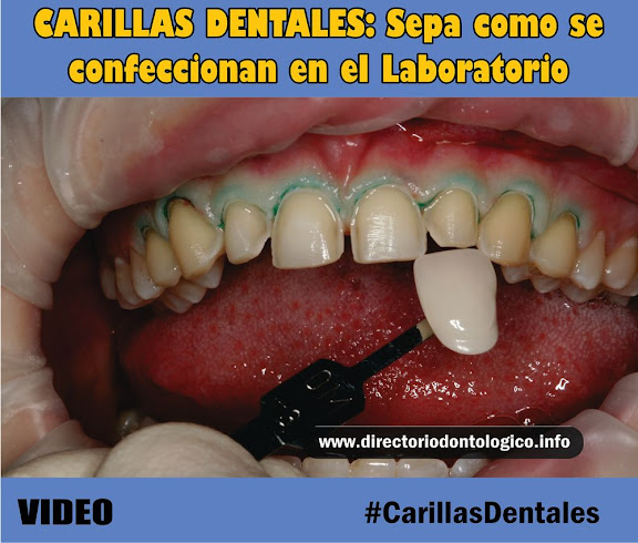 Carillas Dentales