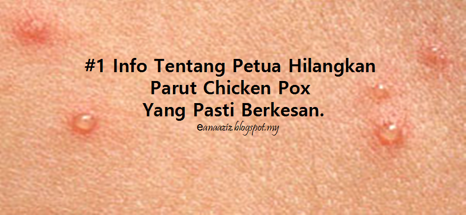 #1 Info Tentang Petua Hilangkan Parut Chicken Pox Yang 