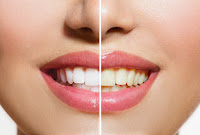 TEETH WHITENING IN NOIDA - CITY DENTAL CENTRE