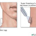 Is It Safe to Cut Off Skin Tags