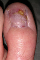 Big Toenail Removal - Left Foot - 12 Weeks & 4 Days