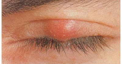 Obat Timbilen Yang Ada Di Apotik Paling Ampuh