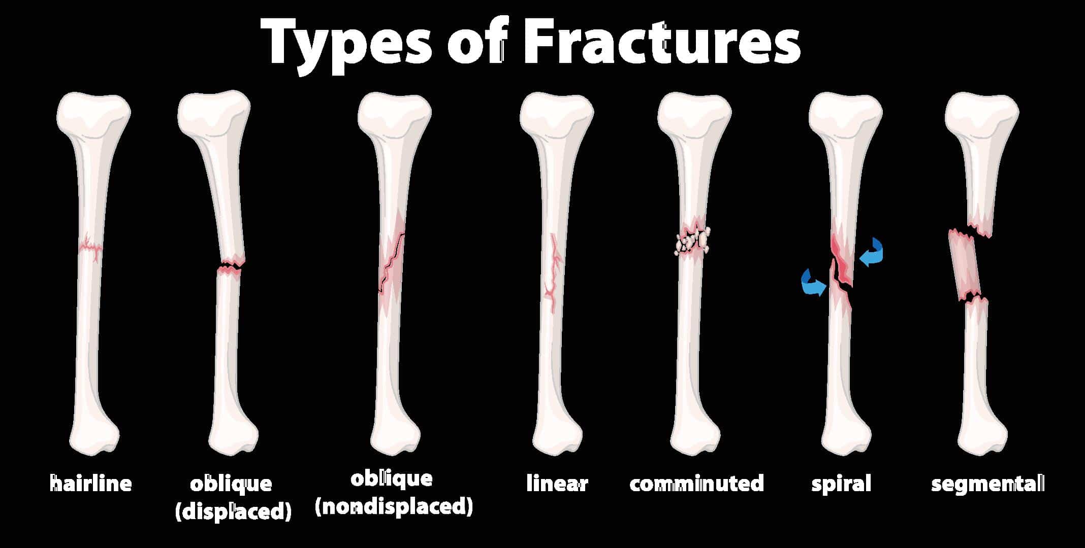 Types of Fractures Bone by Phoenix Ortho and Speciality Clinic