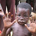 Outbreak of Monkey-Pox in Nigeria