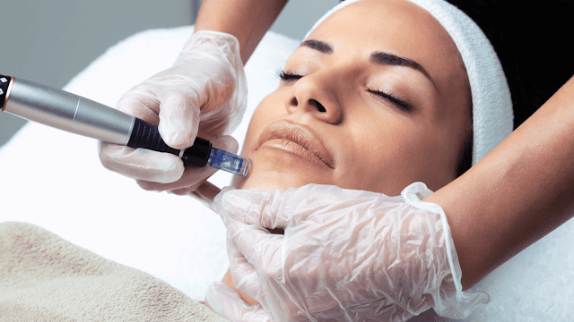 microneedling-treatments-barbies-beauty-bits