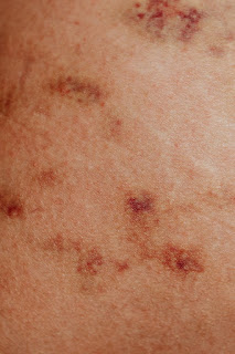 pinpoint red spots on the skin, red spots on the skin, what causes red spots on the skin, can drinking cause red spots on the skin, what are red spots on the skin, what red spots on the skin, red spots on the skin and itching,