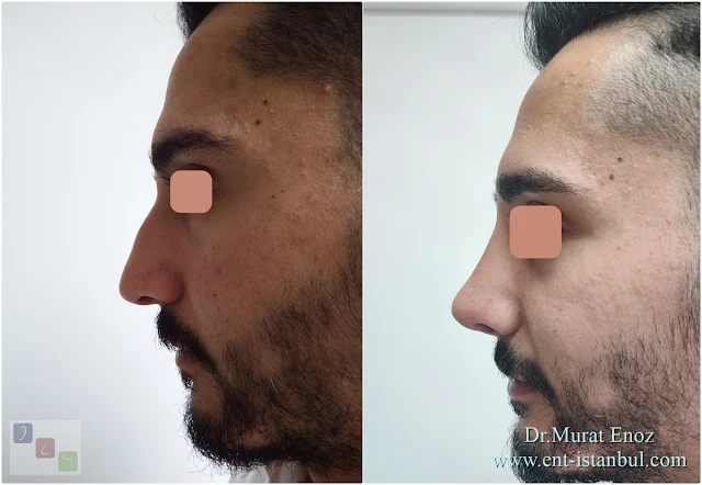 Male rhinoplasty, Nose job for men, Natural nose aesthetic for men