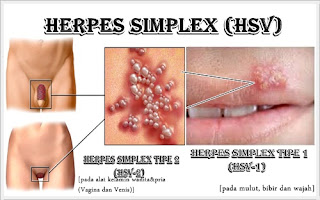 Berapa Harga Obat Herpes Gangjie Ghosiah Di Serdang Bedagai Sei Rampah Sumatera Utara