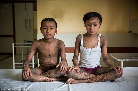 Oh No! Rare Skin Disease Leaves Brother and Sister with Scales all Over Their Bodies (Photos)
