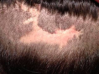 Alopecia Cicatricial