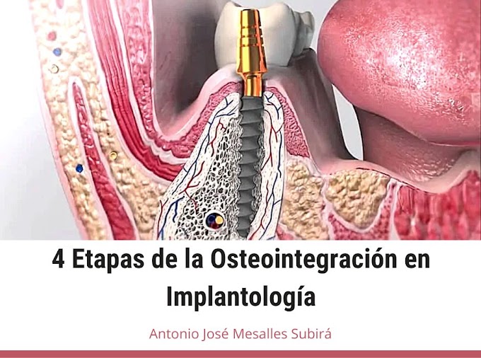 PDF: 4 Etapas de la Osteointegración en Implantología