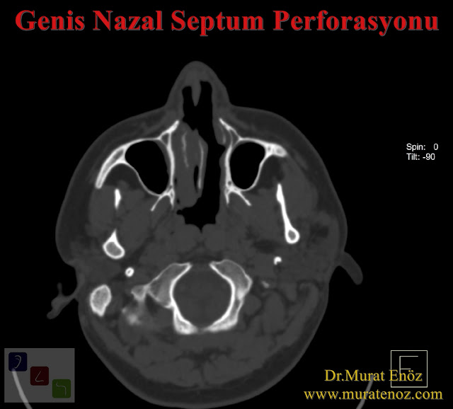 Nazal septum perforasyonu