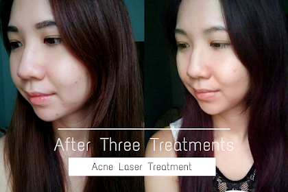 Laser Treatment For Acne With Price