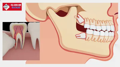 What is Impacted Wisdom Teeth?