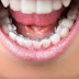 Tìm hiểu về phương pháp niềng răng mặt trong