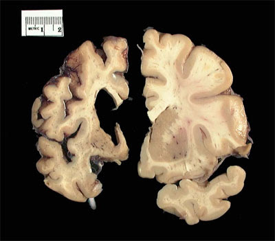 Neuroskeptic: Cannabinoids in Huntington's Disease