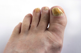 Nail Fungus Onychomycosis