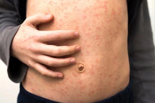 Shocking Outbreaks: Migrant Shelter Health Crisis Revealed!