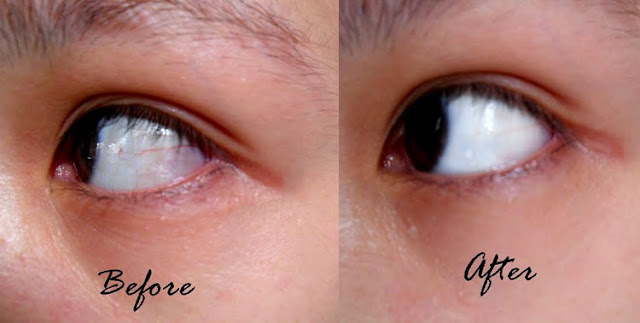 How To Remove Red Eyes Strains And Bloodshot Eyes