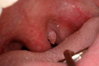 Apa Penyebab Virus Hepatitis C