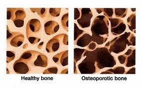 Obat Osteoporosis Herbal