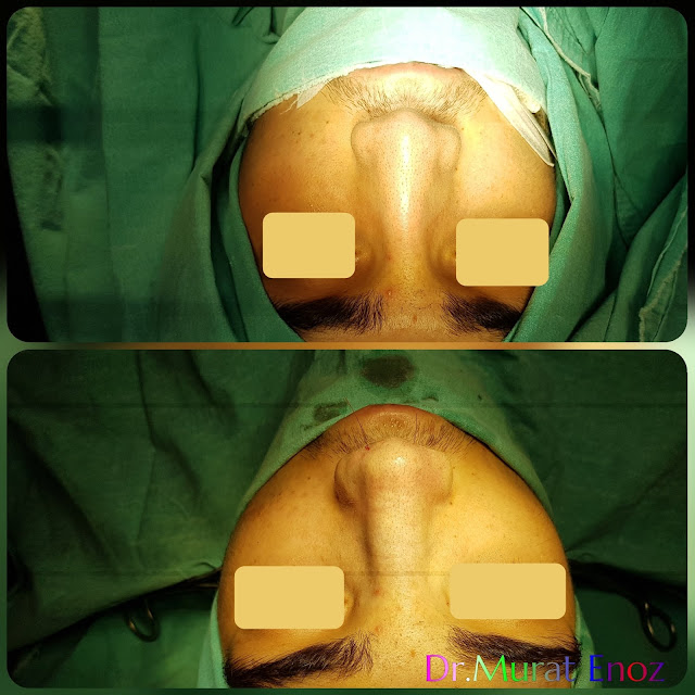 Male thick skinned rhinoplasty, Nose job for men Istanbul Turkey