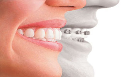 Niềng răng có lợi hay hại gì ?
