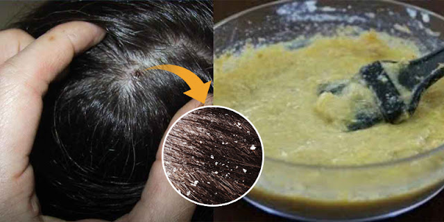 How To Make Homemade Shampoo To Remove Dandruff And Get Silky Hair!