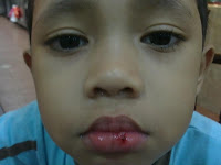 Bibir Azfar luka