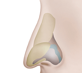 짱이뻐! - Korean Rhinoplasty - Arrowhead Nose Surgery