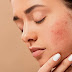  HOW TO REDUCE ACNE OR PIMPLE NATURALLY ?