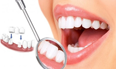 Làm cầu răng sứ có tốt không cho người mất 2 răng? 1