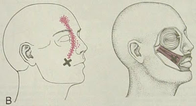 MIOTERAPIA