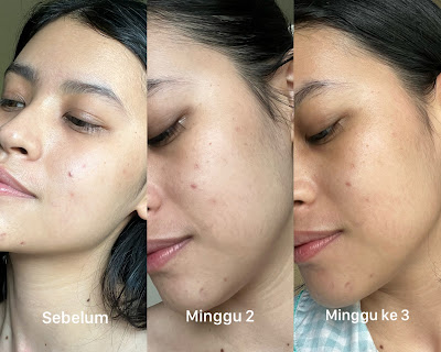 Bekas jerawat memudar setelah menggunakan produk -produk dari Oasea Laboratories by Benedicta Seruni