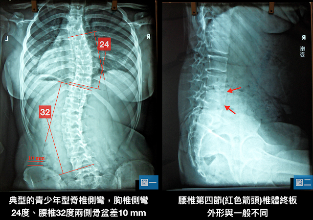 脊椎側彎檢查, 椎間盤突出, 脊椎側彎治療