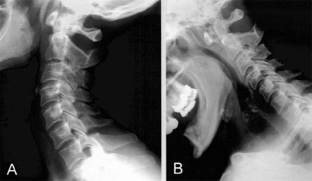 Imaging the Spine in Arthritis: a Pictorial Review | El Paso, TX Chiropractor