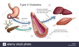 kerintangan insulin