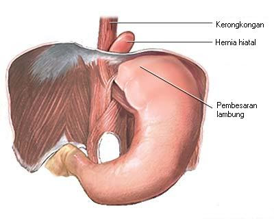 Hernia hiatal