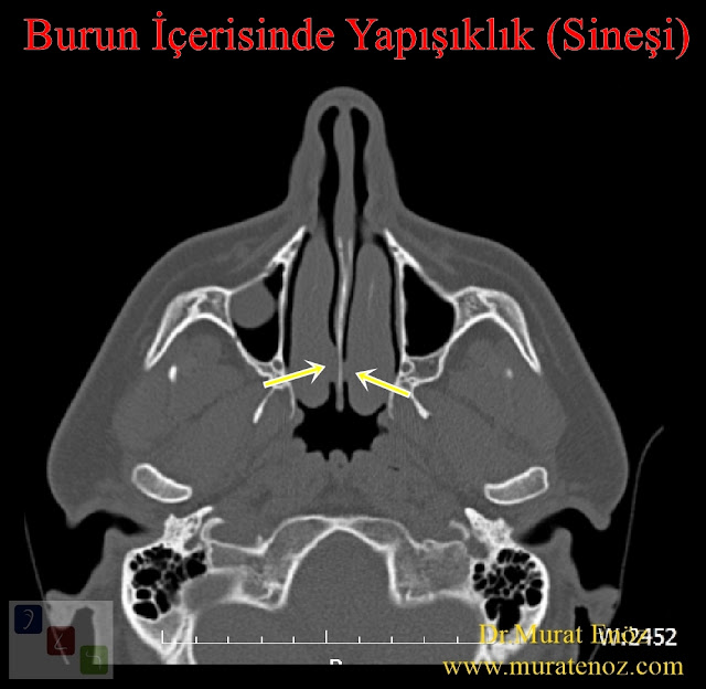 Nazal sineşi - Nazal adezyon - Burun içerisinde yapışıklık - Burun içi sineşi - Burun eti ameliyatı sonrası burun içerisinde yapışıklık - Nazal sineşi tedavisi