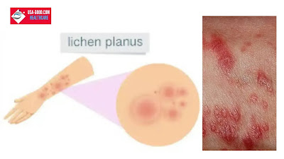What is Lichen planus?