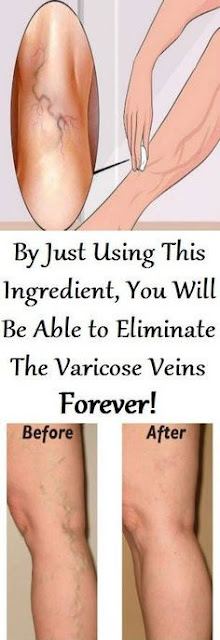 BY JUST USING THIS INGREDIENT, YOU WILL BE ABLE TO ELIMINATE THE VARICOSE VEINS FOREVER!