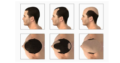 Male Pattern Baldness Affect of Men