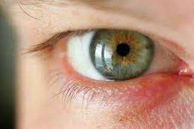 21 Contoh Tentang Jenis Jenis Penyakit Mata dan Gejalanya 