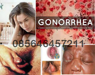 Ciri-ciri Anda Mungkin Mengidap Gonorrhea